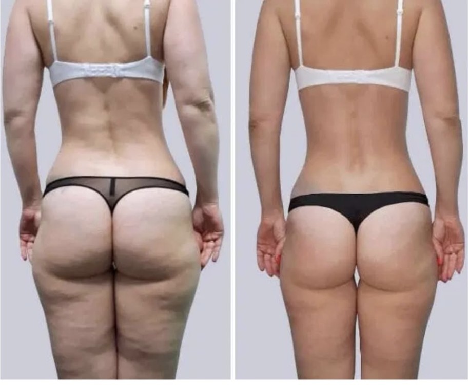 Icoone Laser Med · îngrijire corporală — Înainte · După (stânga → dreapta)