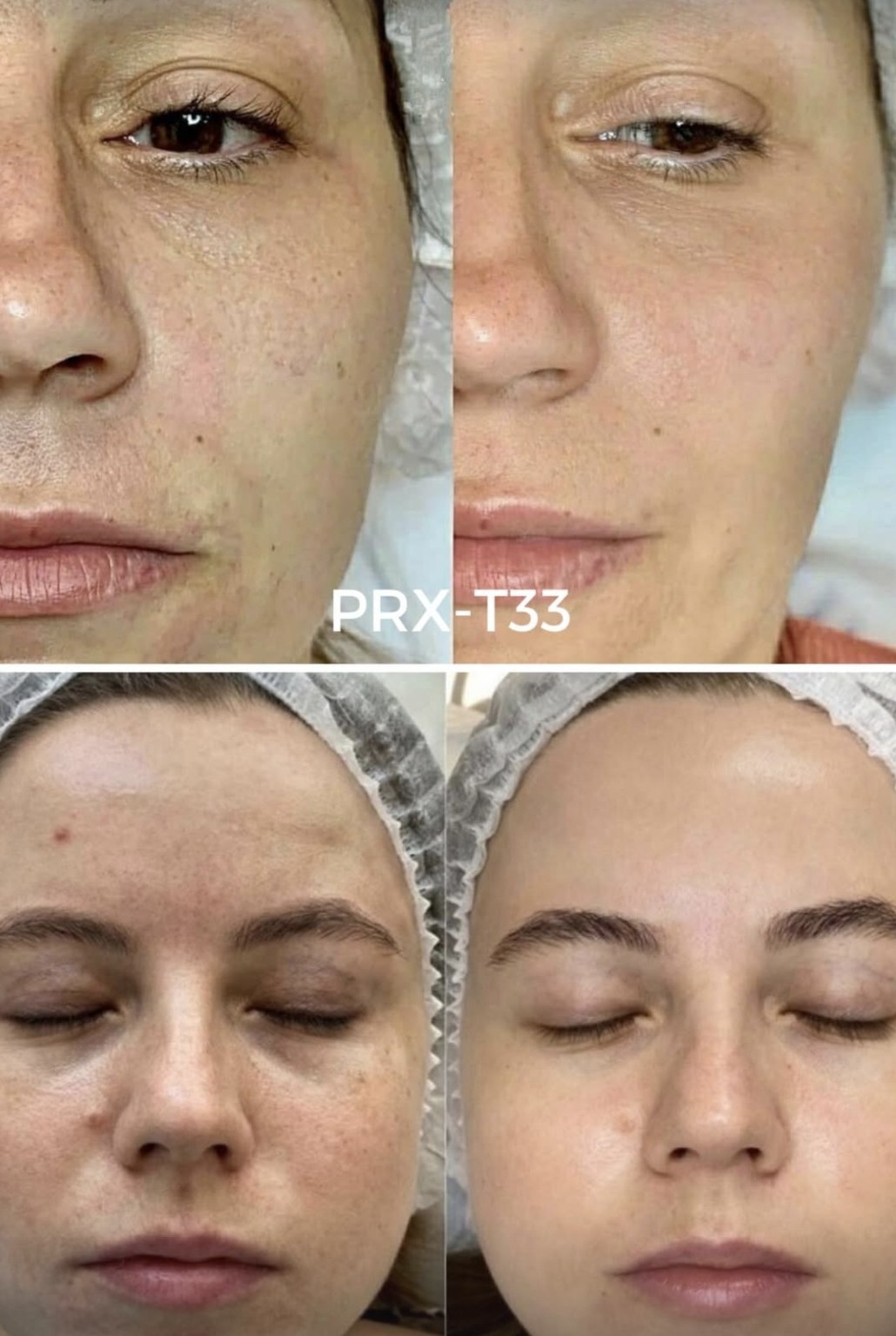 PRX-T33 · comparații fotografice — Înainte · După (stânga → dreapta)