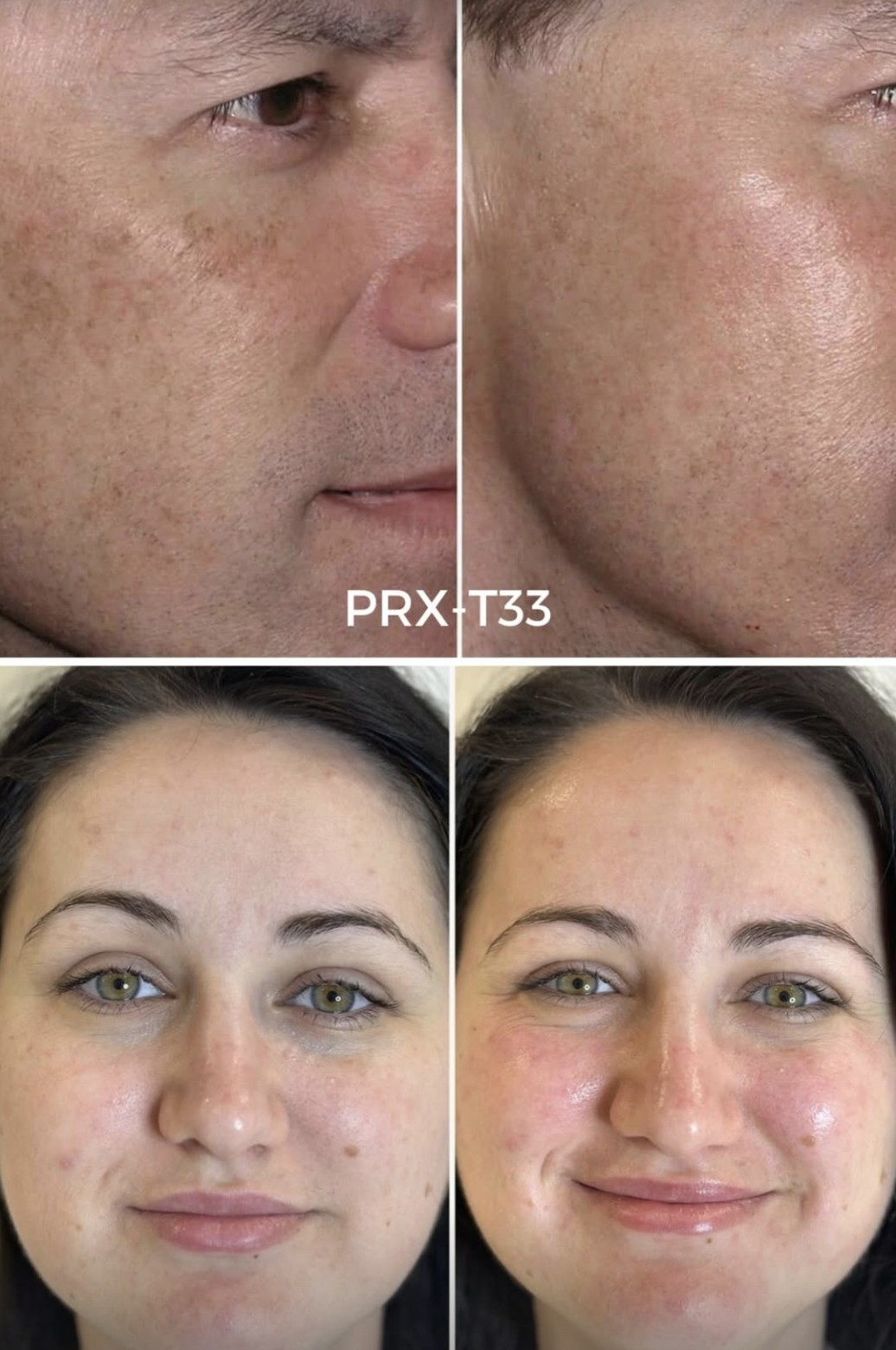 PRX-T33 · exemple faciale — Înainte · După (stânga → dreapta)
